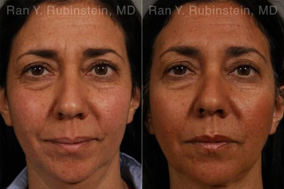 Laser Lift Precision Tx Before and After Photos in Montvale, NJ, Patient 13241