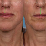 Lip Lift Before and After Photos in Montvale, NJ, Patient 22196