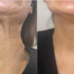 Botox Before and After Photos in Montvale, NJ, Patient 27858