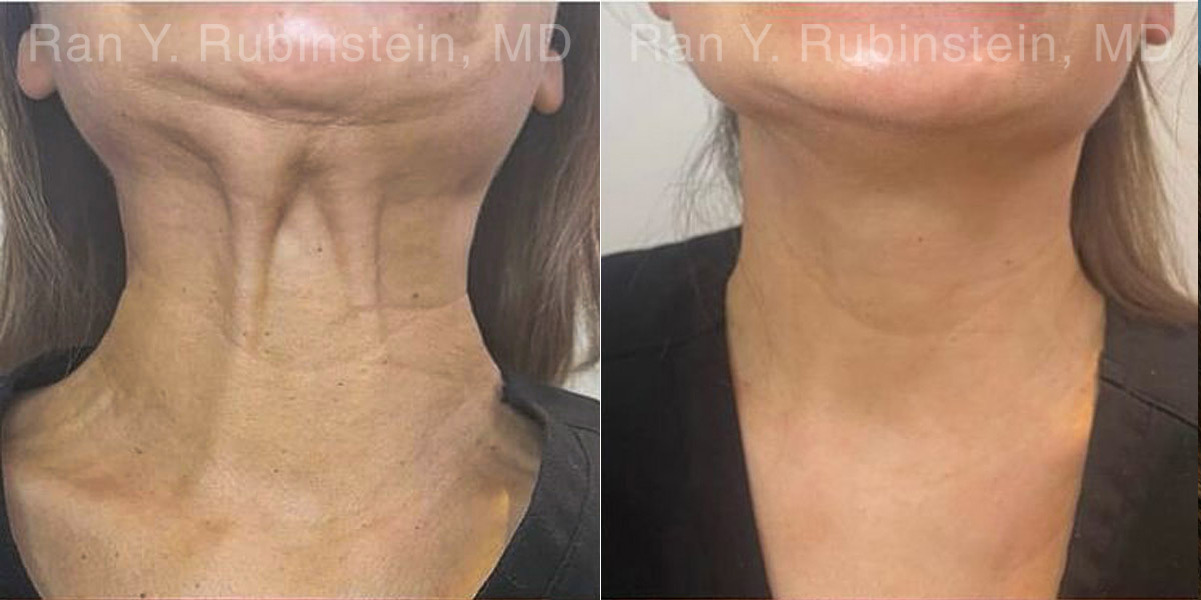 Botox Before and After Photos in Montvale, NJ, Patient 27858