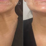 Botox Before and After Photos in Montvale, NJ, Patient 27858