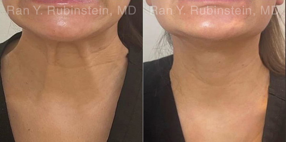 Botox Before and After Photos in Montvale, NJ, Patient 27858