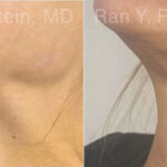 Botox Before and After Photos in Montvale, NJ, Patient 27858