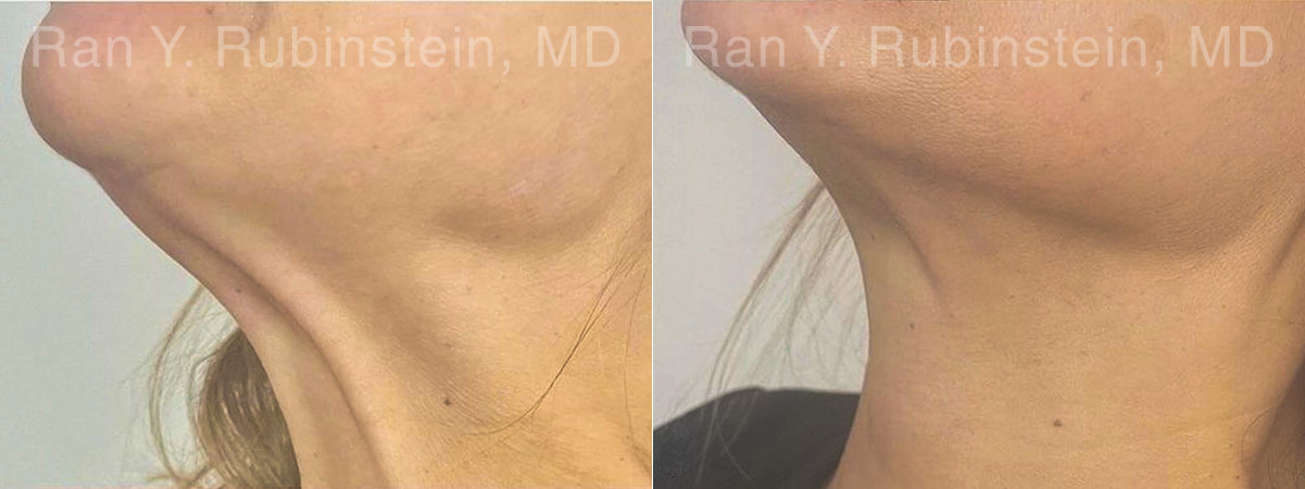 Botox Before and After Photos in Montvale, NJ, Patient 27858