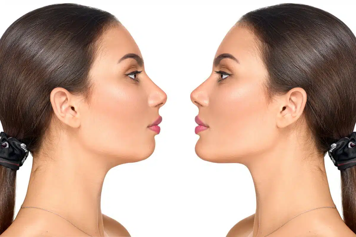 Side-by-side before and after image of a woman showing improved chin projection and facial balance from chin implant.