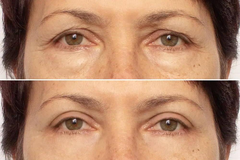 Diagram of modern blepharoplasty showing small incisions and fat repositioning for minimal scarring and natural results.