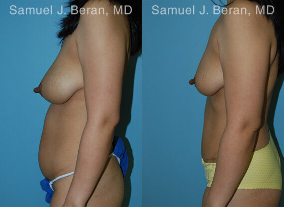 Abdominoplasty Before and After Photos in Montvale, NJ, Patient 12231
