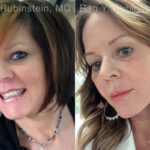 Face lift & Neck lift Before and After Photos in Montvale, NJ, Patient 24825