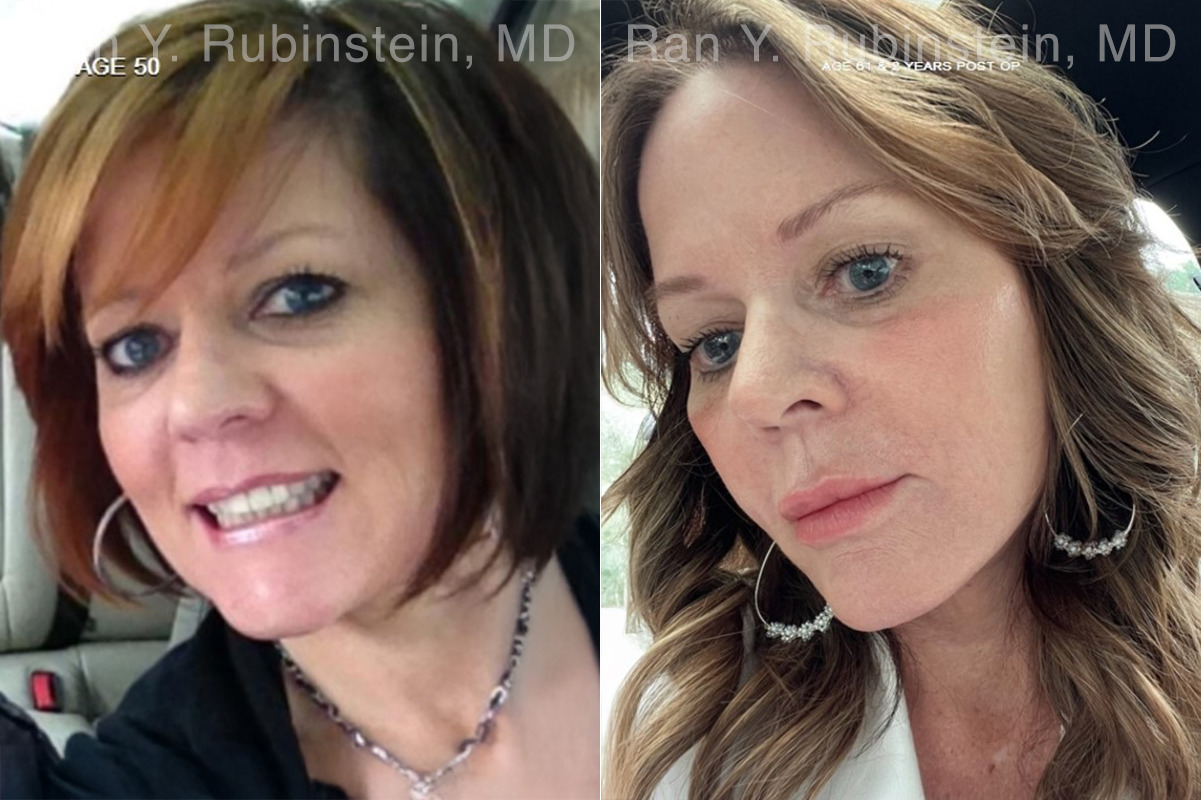 Face lift & Neck lift Before and After Photos in Montvale, NJ, Patient 24825