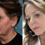Face lift & Neck lift Before and After Photos in Montvale, NJ, Patient 24825