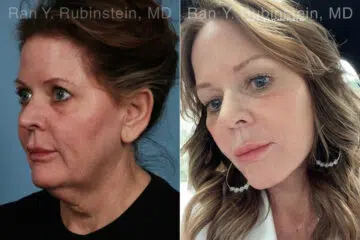 Face lift & Neck lift Before and After Photos in Montvale, NJ, Patient 24825