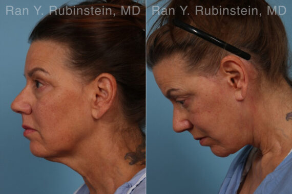 Face lift & Neck lift Before and After Photos in Montvale, NJ, Patient 30463