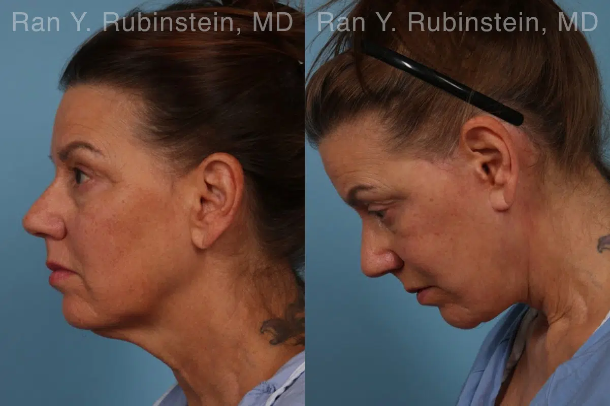 Face lift & Neck lift Before and After Photos in Montvale, NJ, Patient 30463