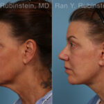 Face lift & Neck lift Before and After Photos in Montvale, NJ, Patient 30463