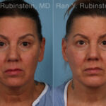 Face lift & Neck lift Before and After Photos in Montvale, NJ, Patient 30463