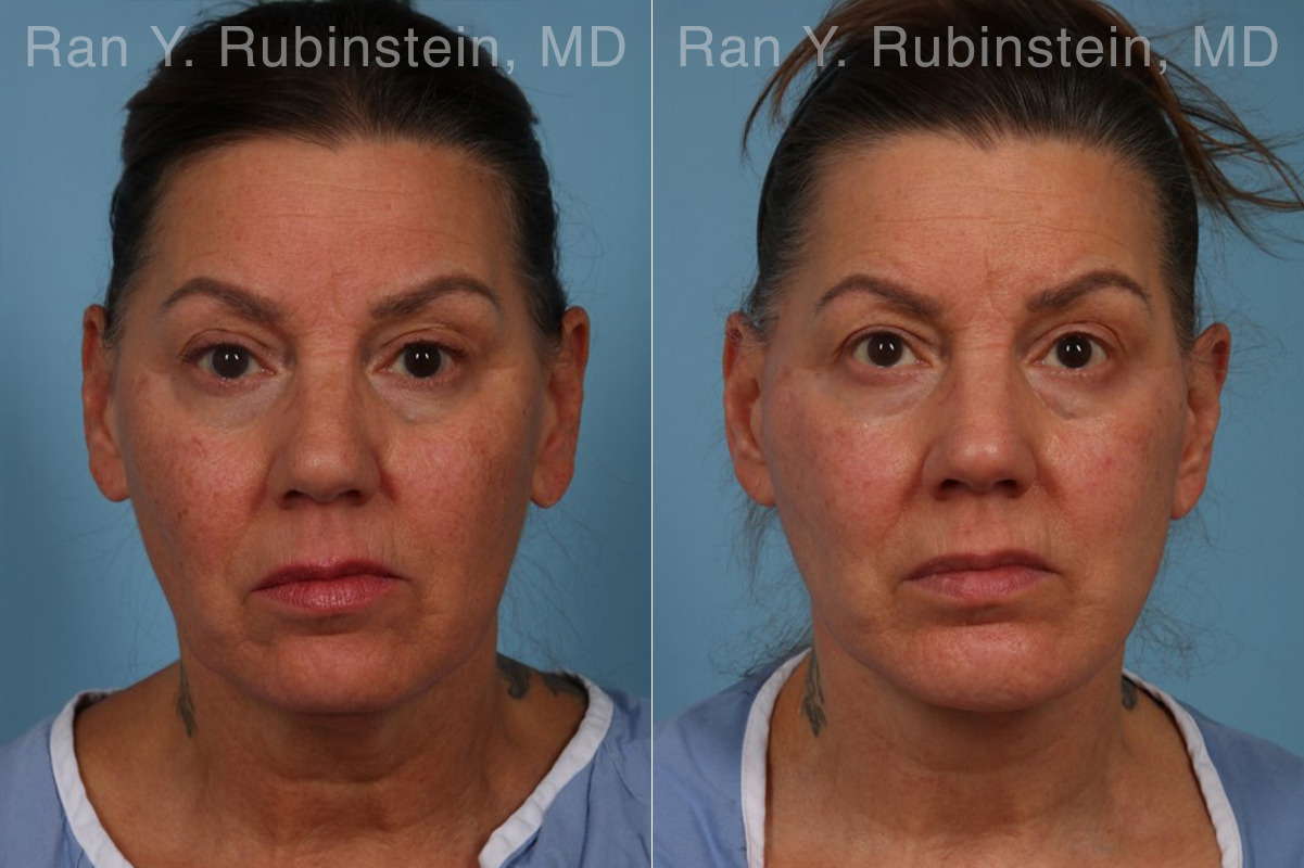 Face lift & Neck lift Before and After Photos in Montvale, NJ, Patient 30463
