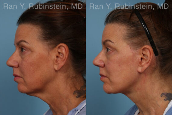 Face lift & Neck lift Before and After Photos in Montvale, NJ, Patient 30463