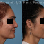 Non-Surgical Rhinoplasty Before and After Photos in Montvale, NJ, Patient 30472
