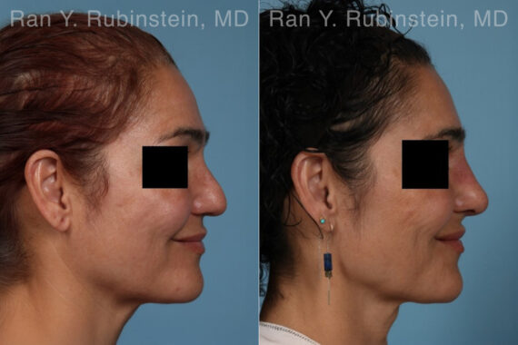 Non-Surgical Rhinoplasty Before and After Photos in Montvale, NJ, Patient 30472