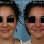 Non-Surgical Rhinoplasty Before and After Photos in Montvale, NJ, Patient 30472