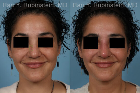Non-Surgical Rhinoplasty Before and After Photos in Montvale, NJ, Patient 30472