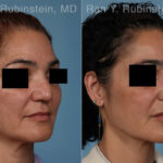 Non-Surgical Rhinoplasty Before and After Photos in Montvale, NJ, Patient 30472