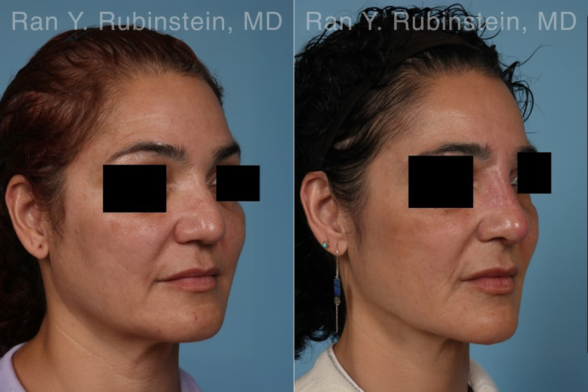 Non-Surgical Rhinoplasty Before and After Photos in Montvale, NJ, Patient 30472