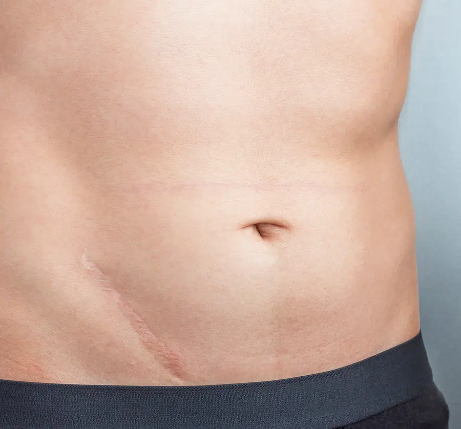 Scars can negatively impact one’s self-esteem, particularly when located on visible areas.
