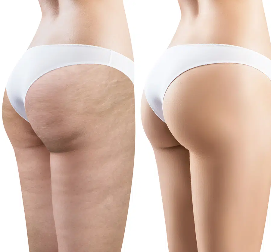 Cellulite occurs regardless of body shape or size and it even occurs in women who are thin and physically fit.