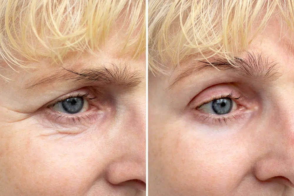 What is Blepharoplasty, and How Does It Improve Your Eyelids?