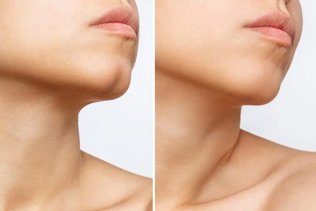 Cleft chin surgery before and after