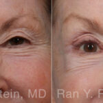 Brow Lift Before and After Photos in Montvale, NJ, Patient 31494