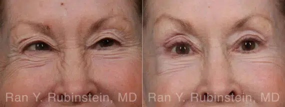Brow Lift Before and After Photos in Montvale, NJ, Patient 31494