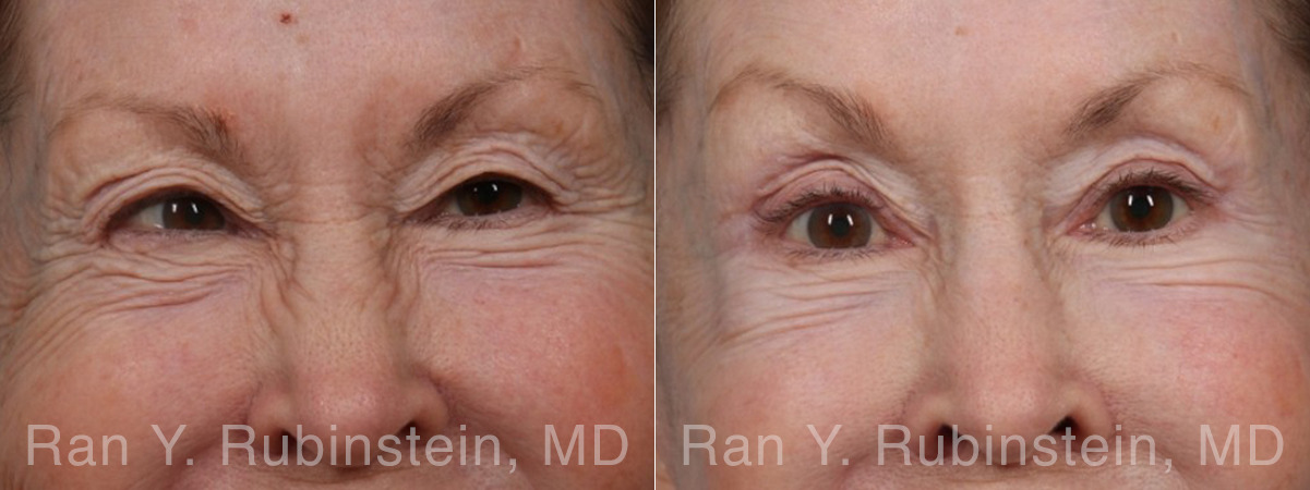 Brow Lift Before and After Photos in Montvale, NJ, Patient 31494
