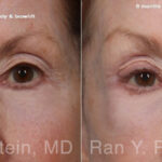 Brow Lift Before and After Photos in Montvale, NJ, Patient 31494