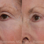 Brow Lift Before and After Photos in Montvale, NJ, Patient 31494