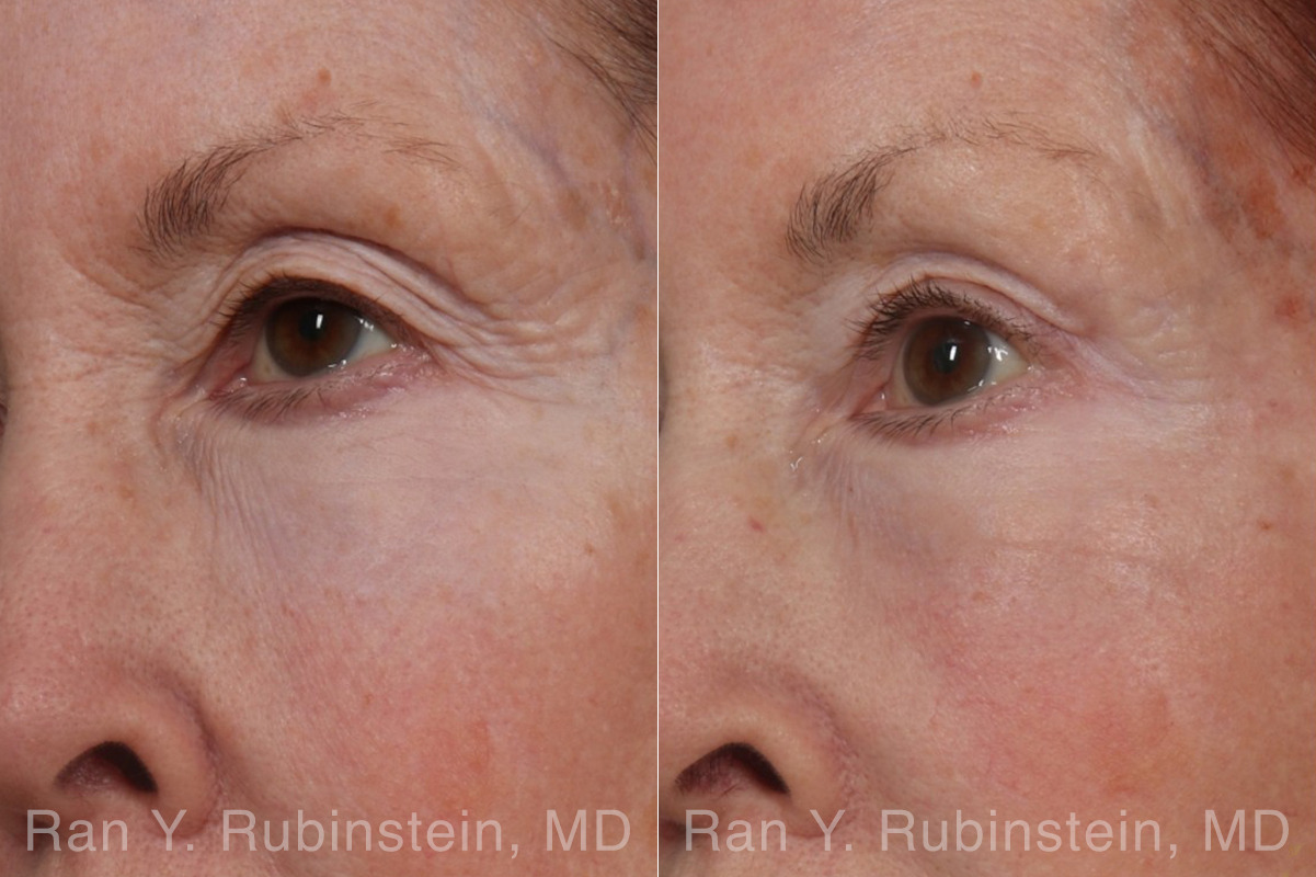 Brow Lift Before and After Photos in Montvale, NJ, Patient 31494