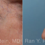 Brow Lift Before and After Photos in Montvale, NJ, Patient 31494
