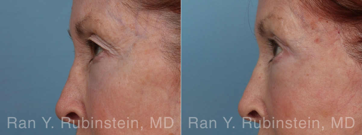 Brow Lift Before and After Photos in Montvale, NJ, Patient 31494