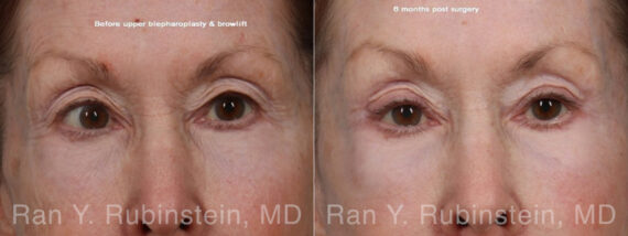 Brow Lift Before and After Photos in Montvale, NJ, Patient 31494