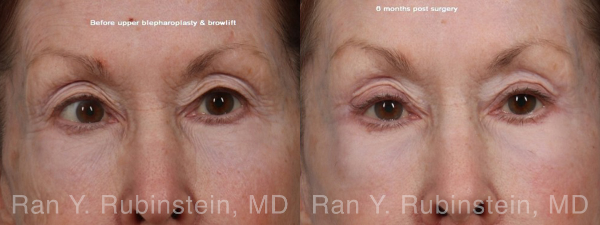 Brow Lift Before and After Photos in Montvale, NJ, Patient 31494