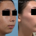 Chin Augmentation Before and After Photos in Montvale, NJ, Patient 31512
