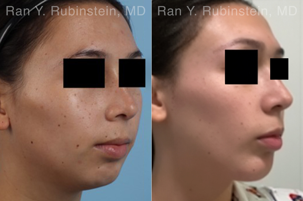 Chin Augmentation Before and After Photos in Montvale, NJ, Patient 31512
