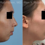 Chin Augmentation Before and After Photos in Montvale, NJ, Patient 31512