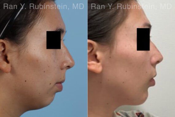 Chin Augmentation Before and After Photos in Montvale, NJ, Patient 31512