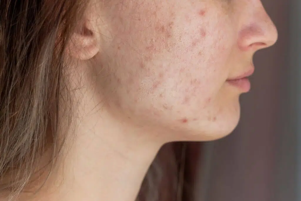 Close-up of cheek with visible acne scars and uneven texture caused by collagen damage and past breakouts