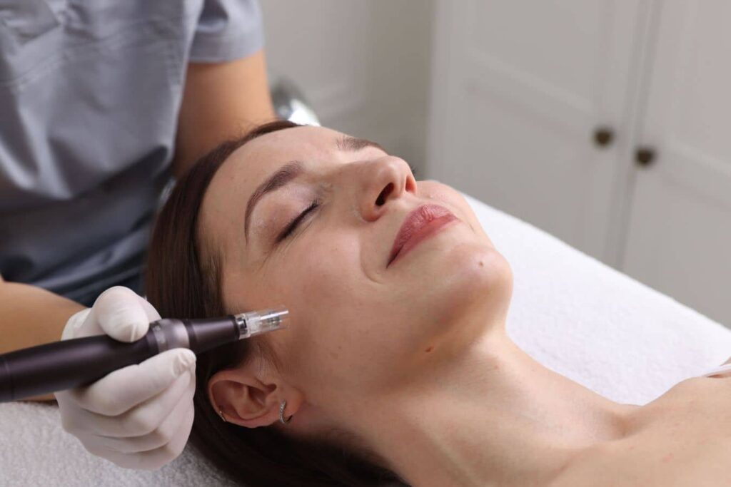 Patient receiving microneedling treatment to improve acne scars and boost collagen as part of combination skin therapy