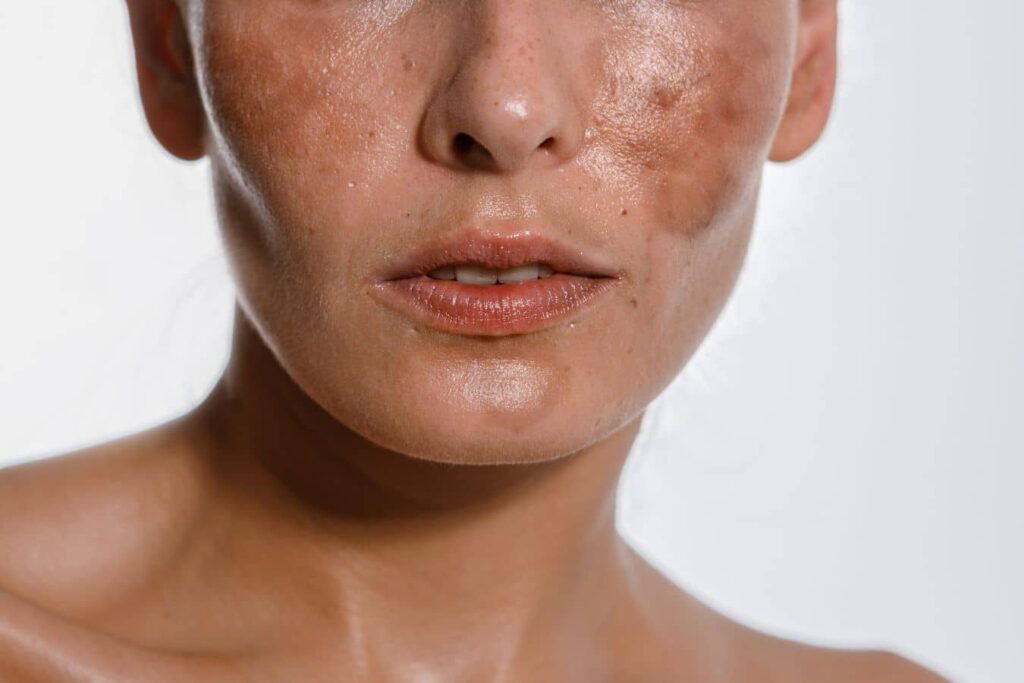 Detailed view of facial skin with melasma and uneven tone, representing microneedling treatment benefits