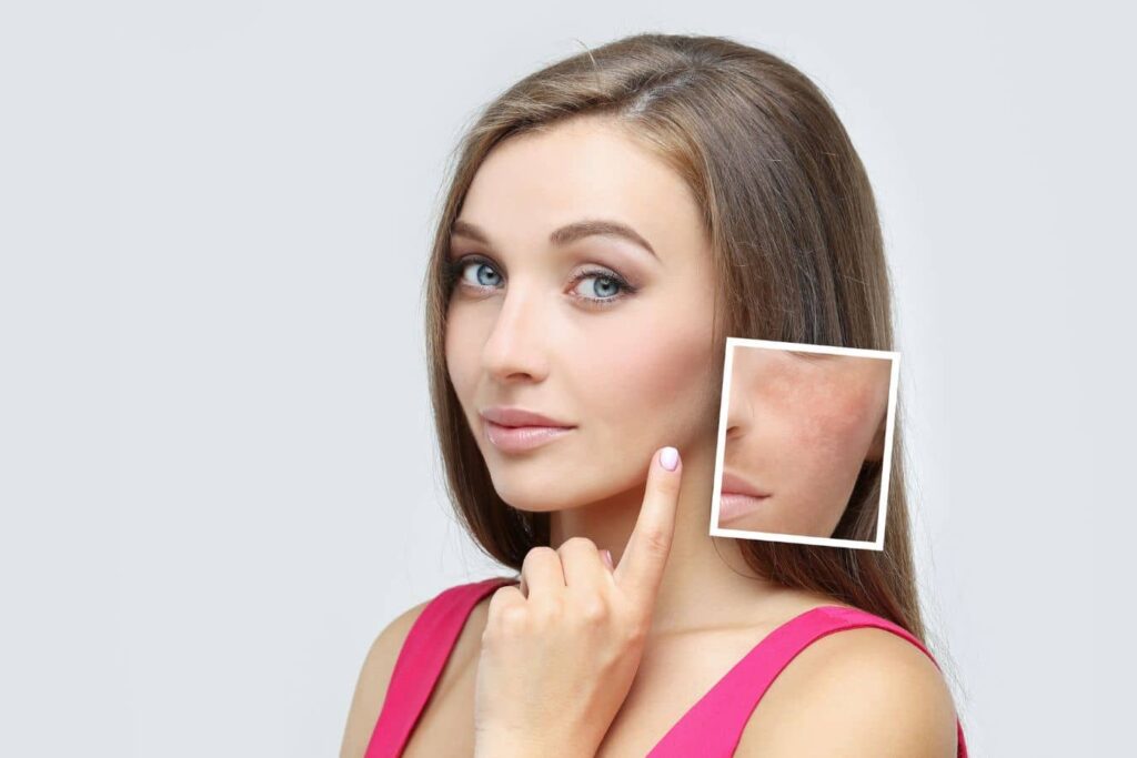 Woman indicating cheek with enlarged view of uneven pigmentation, representing microneedling with combination skincare treatments