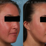 Laser Treatments Before and After Photos in Montvale, NJ, Patient 32259